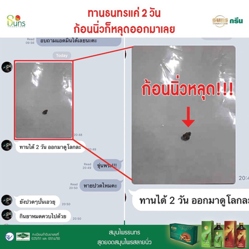 สมุนไพร,ธนทร,นิ่ว,นิ่วในไต,นิ่วในกระเพาะปัสสาวะ,รักษานิ่ว,ปัสสาวะขัด,ยาน้ำ