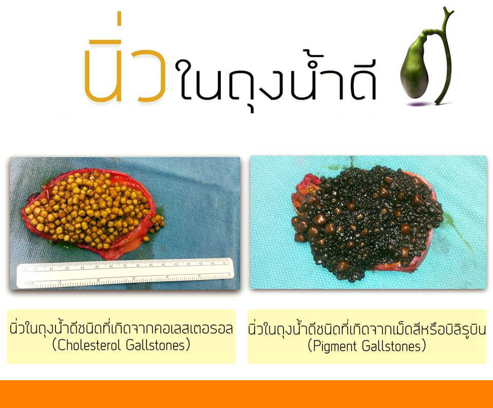 นิ่วถุงน้ำดี,รักษานิ่วในถุงน้ำดี,สลายนิ่วในถุงน้ำดี,ยาสลายนิ่ว,สมุนไพร,ธนทร,นิ่ว,นิ่วในไต,นิ่วในกระเพาะปัสสาวะ,รักษานิ่ว,ปัสสาวะขัด,ยาน้ำ,สมุนไพรธนทร